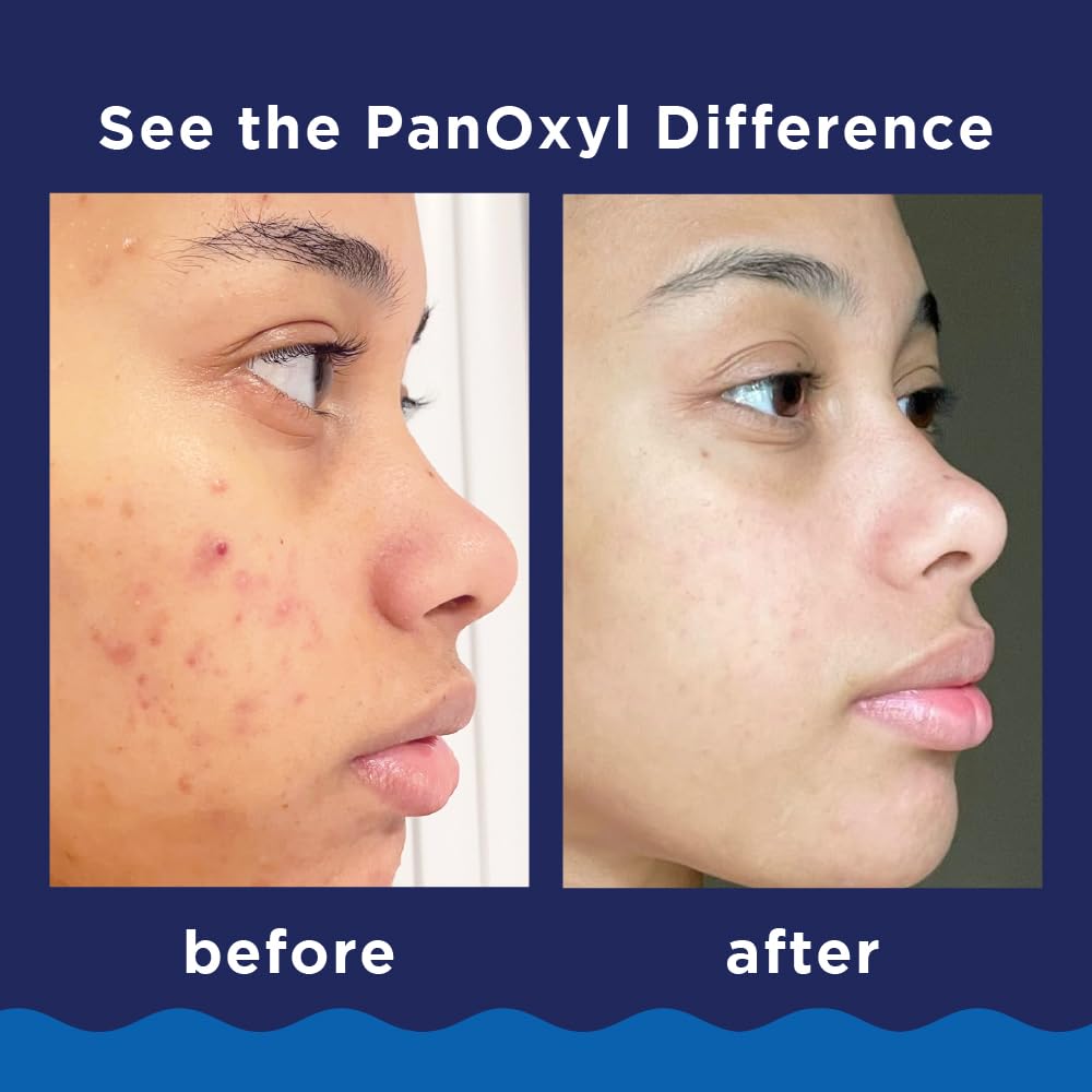 PanOxyl - Acne Foaming Wash Benzoyl Peroxide 10% - 156g